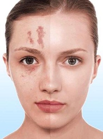 Maquillaje para disimular cicatrices